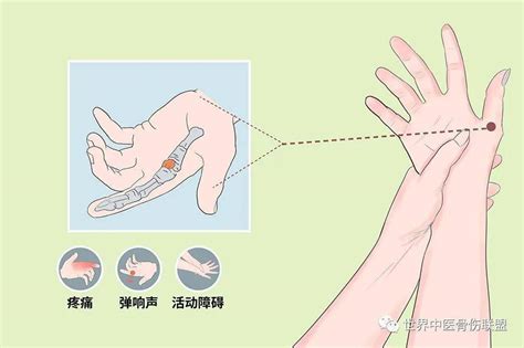 指根|手指腱鞘炎的自我诊断和自我治疗